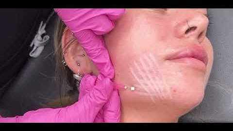 What is PDO Thread Lift ?  Quick 1 hour Facelift #beauty #threads #threadlift 