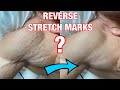HOW to get rid of STRETCH MARKS