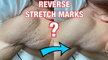 Do natural bodybuilders get stretch marks?