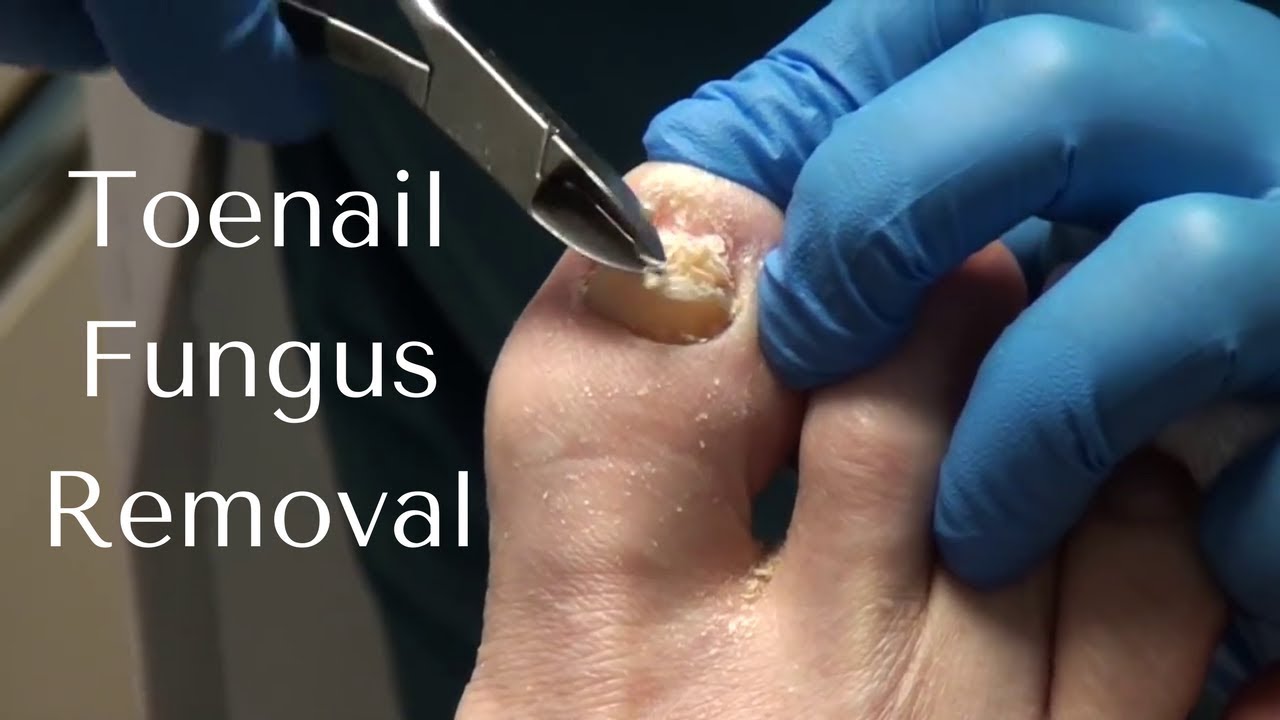 Toenail Fungus Removal How to Cut Toenail Fungus YouTube