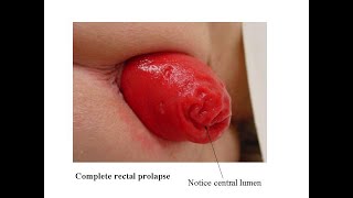 rectal prolapse