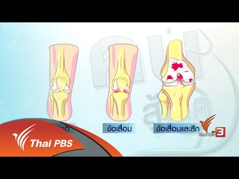 ปรับก่อนป่วย : กายภาพบำบัดแก้อาการข้อเข่าเสื่อม (17 ก.ค. 60)