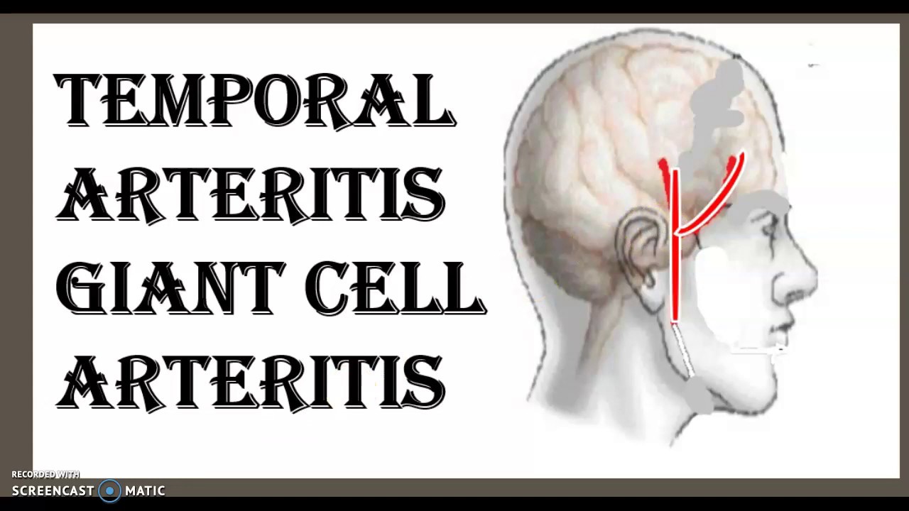 Geant Cell Arteritis GCA Temporal Arteritis circulatory system