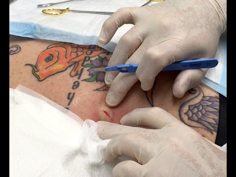 Jillian Epidermal Cyst Redux, Koi Tats & Pond!