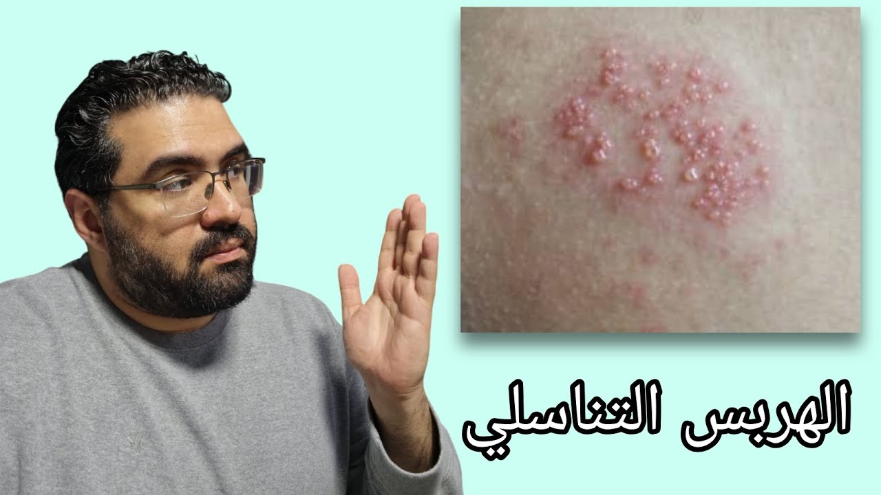 عيادة الجلدية - حلقة ٦ - الهربس التناسلي