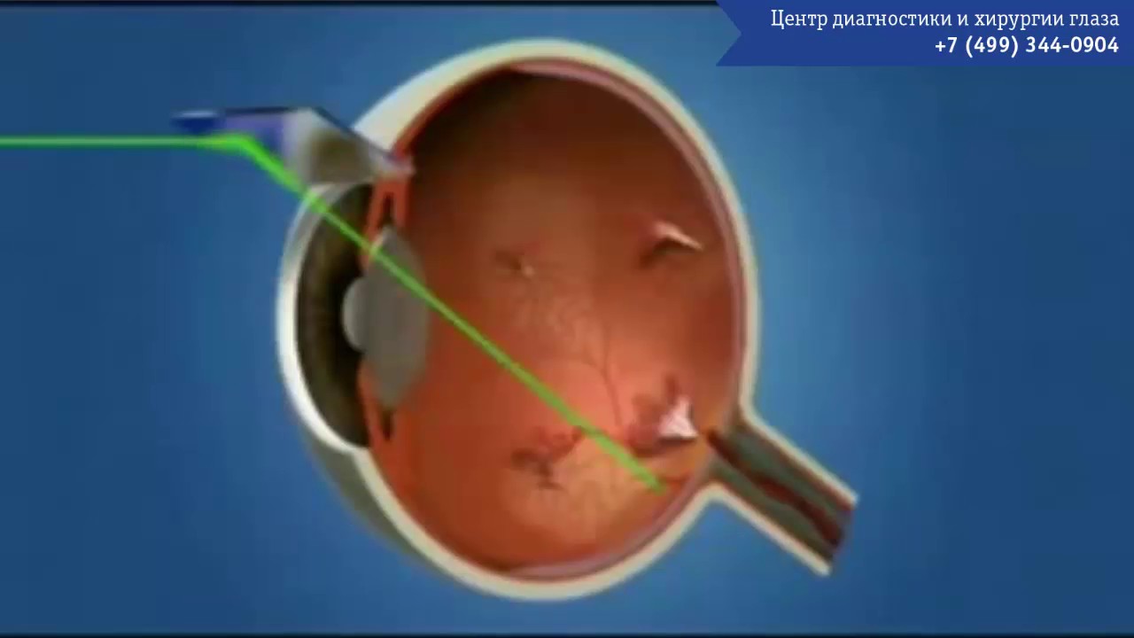 Непролиферативная и пролиферативная диабетическая ретинопатия - YouTube