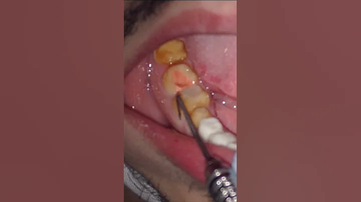 Can dentist repair missing enamel? (2023)