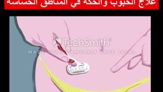 علاج الحبوب والحكة الشديدة بعد الحلاقة بالموس في المناطق الحساسة للنساء Epilation Youtube