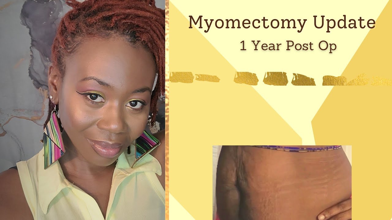 Health Update 1 Year Post Op Myomectomy Update YouTube