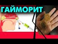 Гайморитті емдеу жолдары | #гайморит