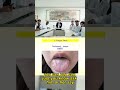Tongue Tooth-marks And The Manifestation #tcm #tongue #indigestion
