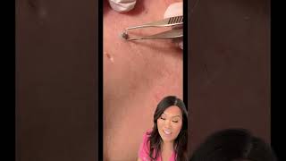Some great blackheads and DPOWs on the back