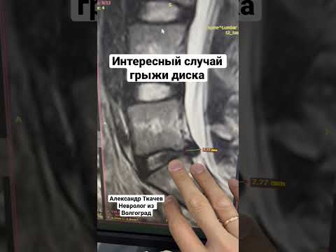 Интересный случай грыжи позвоночника. L5/S1.