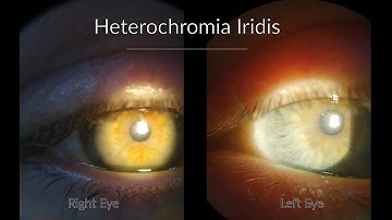 Fuchs Heterochromic Iridocyclitis -  Ophthalmology cases
