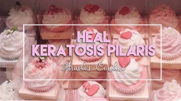 ♡ Heal Keratosis Pilaris ♡