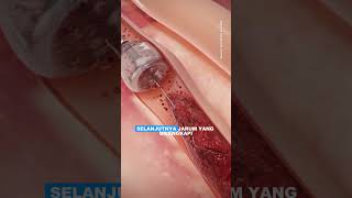 Solusi Penyumbatan Pembuluh Darah shorts