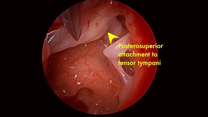 Description of operation for grommet /ventilation tube insertion — Mr  Christopher Pepper FRCS