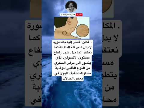 المكان المشار إليه بالصورة لا يدل على قلة النظافة كما نعتقد إنما يدل على ارتفاع مستوى الانسولين ا