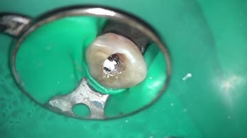 MTAセメントを使用した根管充填