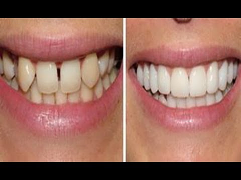 How to Straighten Teeth Without Braces - Get straight ...