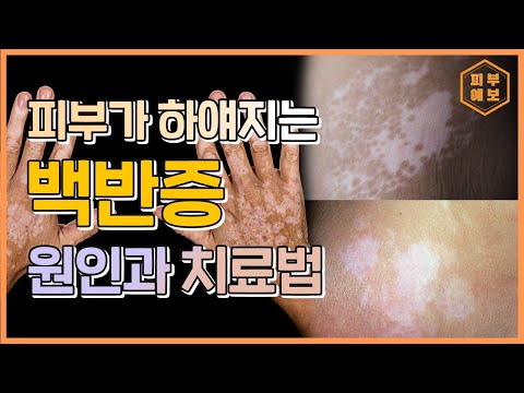 피부가 하얘지는 백반증에 대한 모든 것! 이 한편만 보시면 됩니다 [오체안 피부과 심지현 원장]