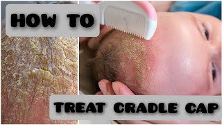 How to Treat Cradle Cap.Newborn baby. #newborn #cradlecap screenshot 3