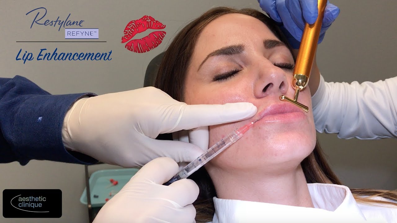 Restylane Refyne Lip Enhancement
