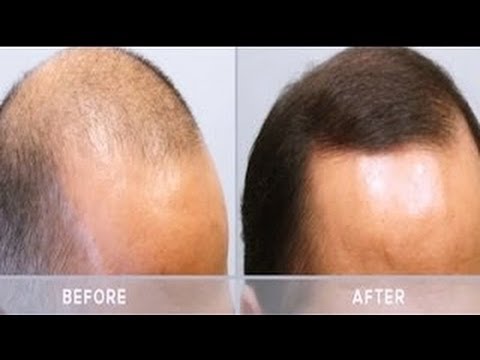 What are the side effects of minoxidil for beard growth? 