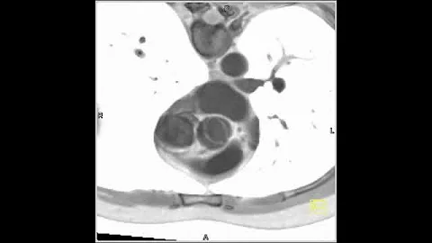 4D Imaging of the Aortic Valve: Bicuspid Aortic Valve (2 of 2)