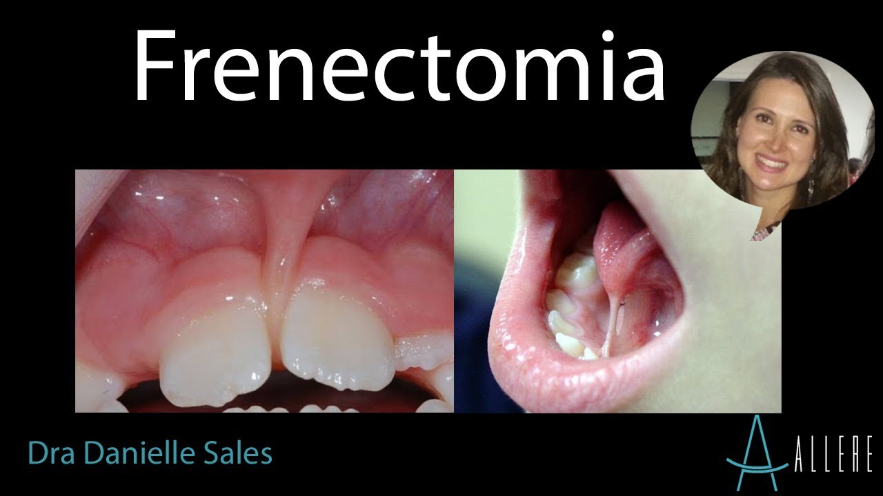 FRENECTOMIA O que é e quando preciso fazer? DRA DANIELLE SALES YouTube FRENECTOMIA O que é e quando preciso fazer? DRA DANIELLE SALES YouTube