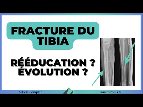 Vidéo: 3 façons de traiter les attelles de tibia