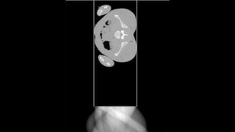 Radon Transform: Pelvis