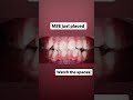 Timelapse MSE space 0-8 weeks #marpe #mse #airway #smile #face