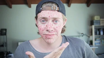 Do charcoal pills help with acne?