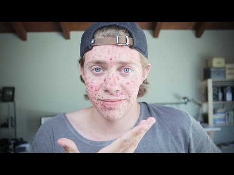 How I Cured My Acne