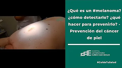 ¿Qué se siente al principio de un melanoma?