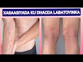 Xasasiyada maqaarka labatada allergic dermatitis wax kene calamadaha lagu garto dr mahamed liban