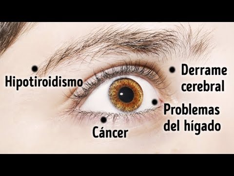 Vídeo: Ojo Infectado: 8 Causas Comunes