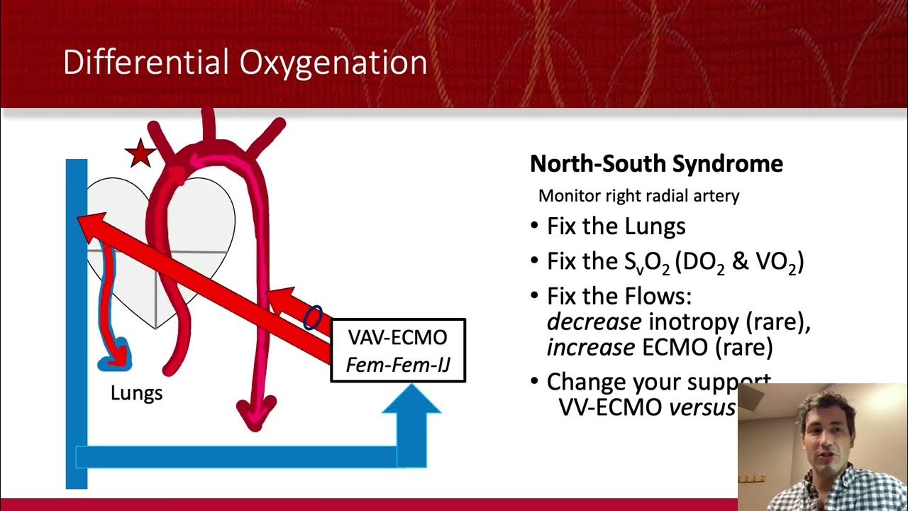 ECMO VA ECMO For Dummies! YouTube