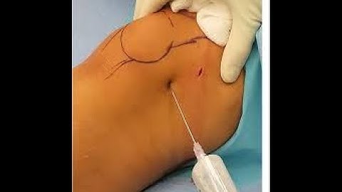 Arthrotomy Knee CPT code - simplify medical coding