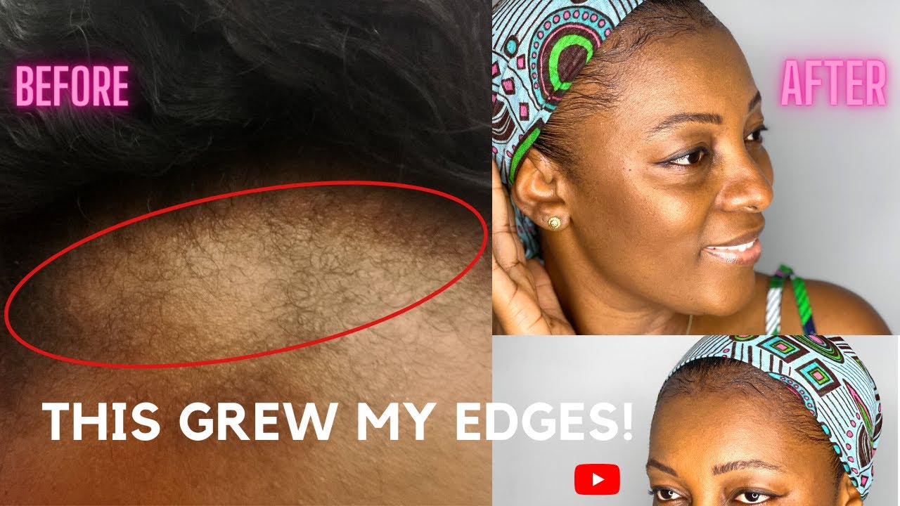 THIS IS HOW I GREW BACK MY EDGES AFTER MY WIGS DAMAGED MY HAIRLINE. FINALLY MY EDGES ARE