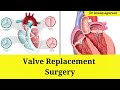 Heart valve replacement surgery: What you need to know