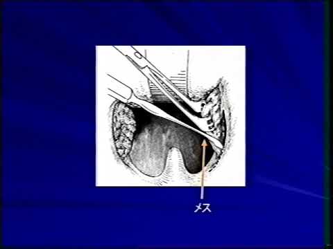 口蓋扁桃摘出術（藤田医大耳鼻咽喉科教材）