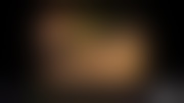 Diverticulum Cannulation | ERCP | Endoscopic Retrograde Cholangio-Pancreatography