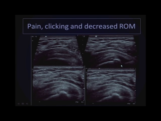 Pearls and Pitfalls in Musculoskeletal Ultrasound