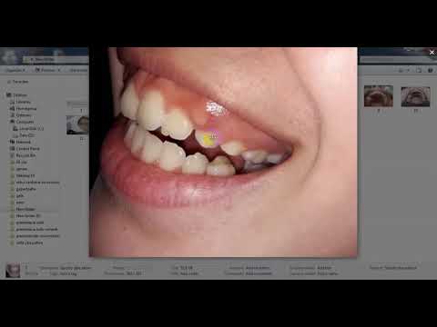 ვიდეო: როგორ გამოვიყვანოთ სარძევე კბილი