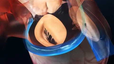 Carillon Device Implantation