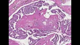 Histopathology Breast--Ductal carcinoma in situ