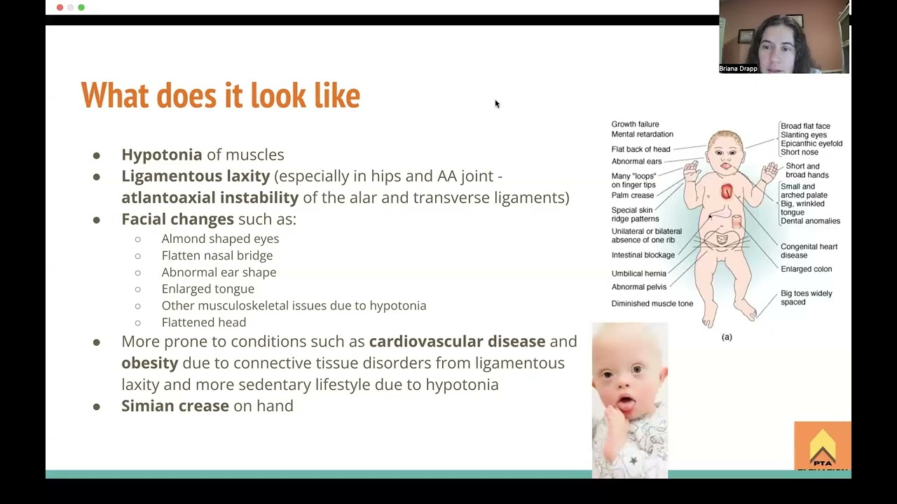 Down Syndrome - NPTE Prep