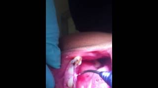 Thumbnail of Fibroma Removal With Zolar Dental Diode Laser